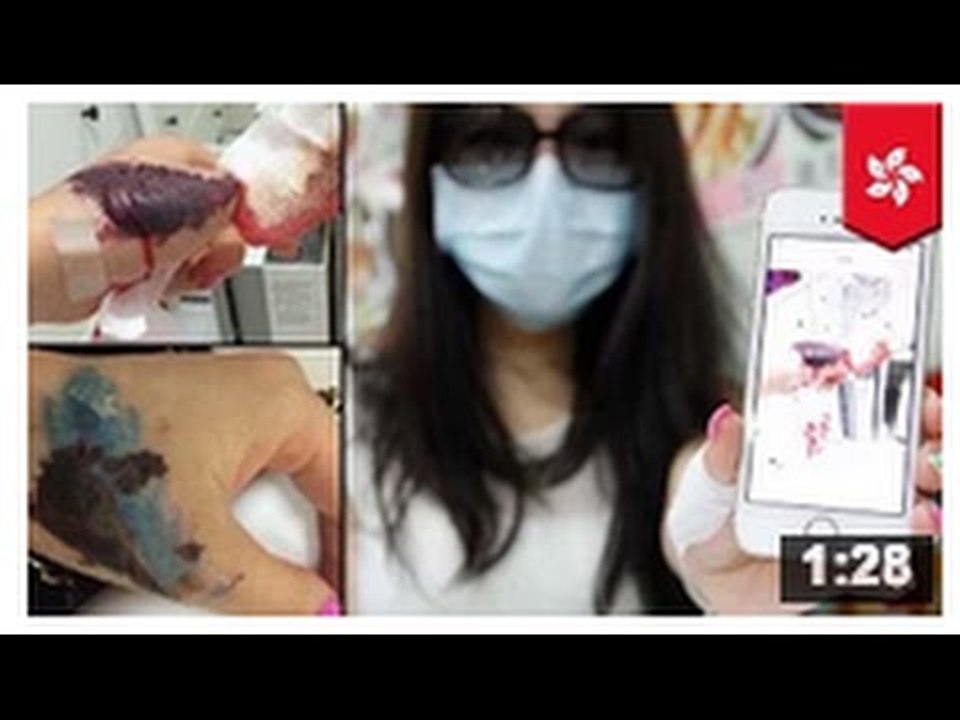 DÉTATOUAGE: Une femme tente de se faire enlever un tatouage et fini avec une greffe de peau.