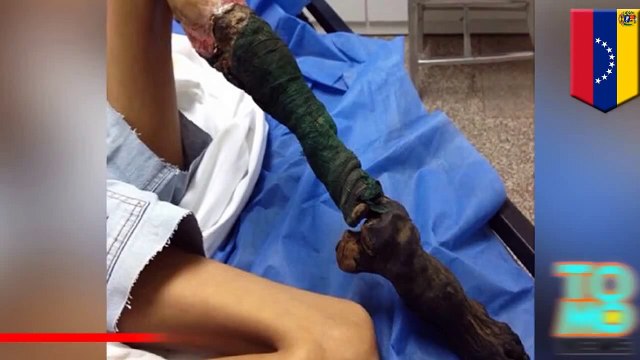 لدغة ثعبان تسبب التعفن في ساق فتاة ونخر بالغ