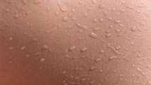 How is eczema treated?: How To Treat Eczema