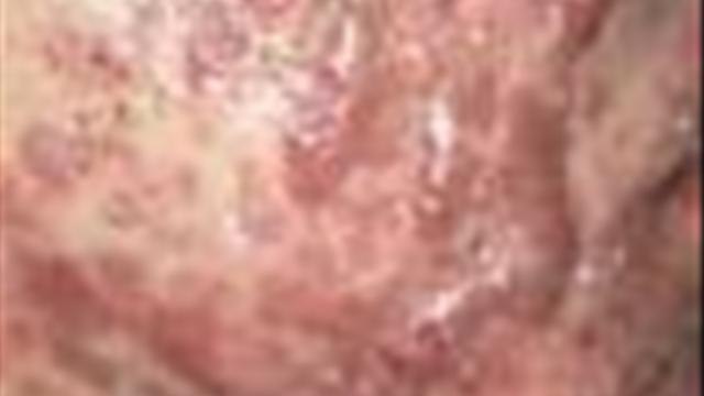 How To Get Cystic Acne Treatment