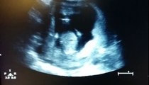¡Bebé da palmadas dentro del útero!