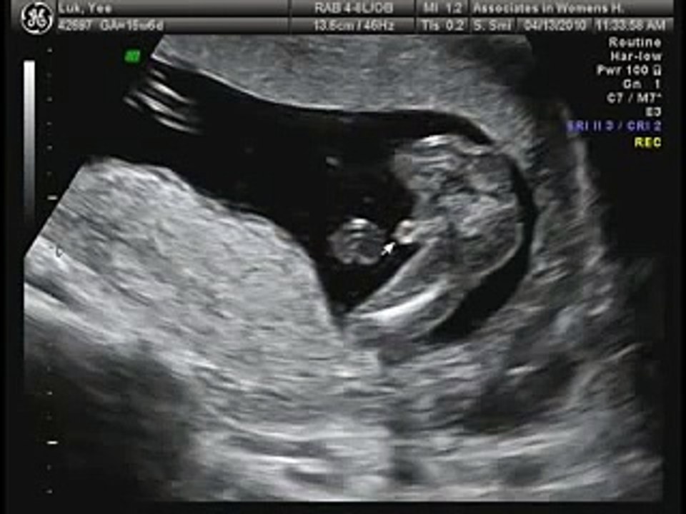 16 Weeks Ultrasound It S A Boy Video Dailymotion
