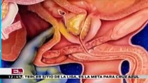 Cáncer de próstata: Síntomas y Factores de riesgo/ Salud con Gloria Contreras