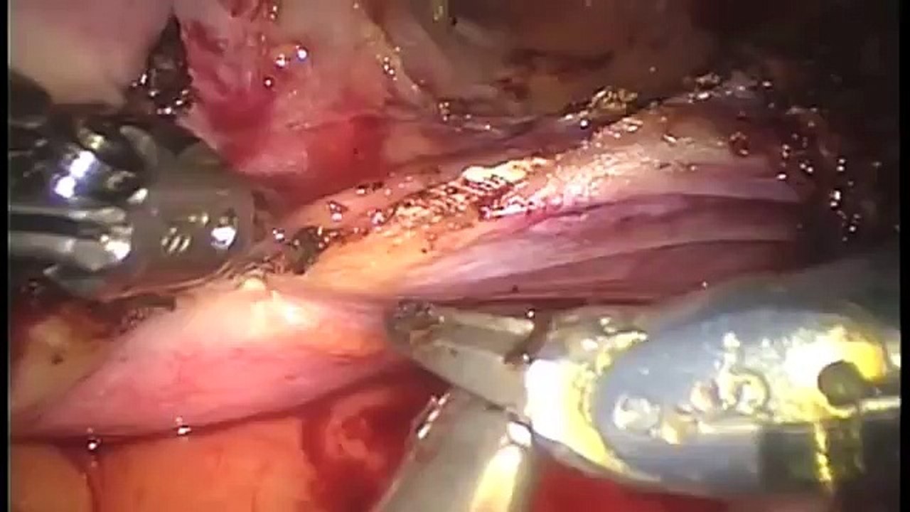 da Vinci Robotic Hysterectomy