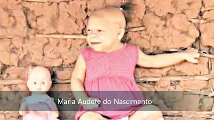 30-Year Old Brazilian Woman Looks Like a 9-Month Baby- Maria Audete do Nascimento