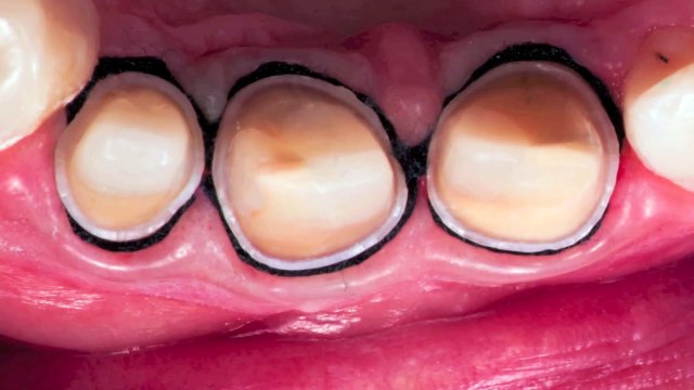 Tooth preparation under microscope, root canal treatment. Nazariy Mykhaylyuk