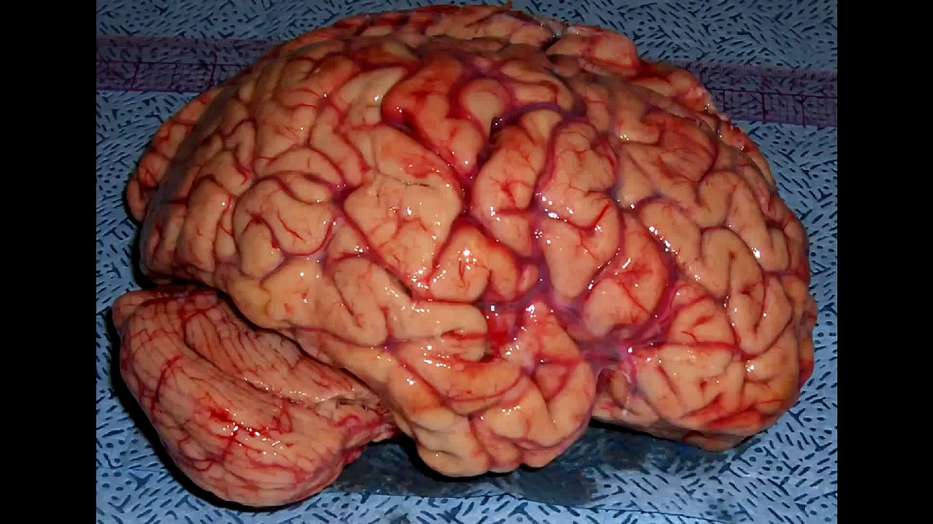 Neuroplasticity Documentary