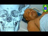 Brasileño con un cuchillo clavado en su cabeza conduce por más de dos horas hasta un hospital