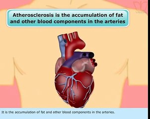 Atherosclerosis CBSE-12 biology