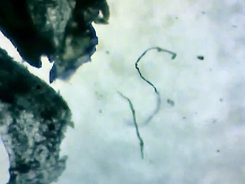 Conversation With Morgellons GMO Fiber