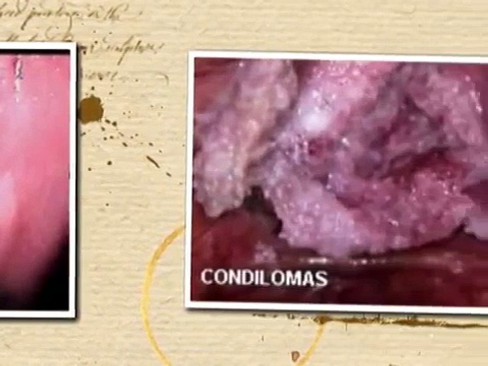 Colposcopía  -Imagenes-