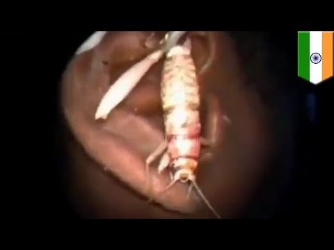 Video de hombre en la india que tenia un enorme insecto en el interior de su oído