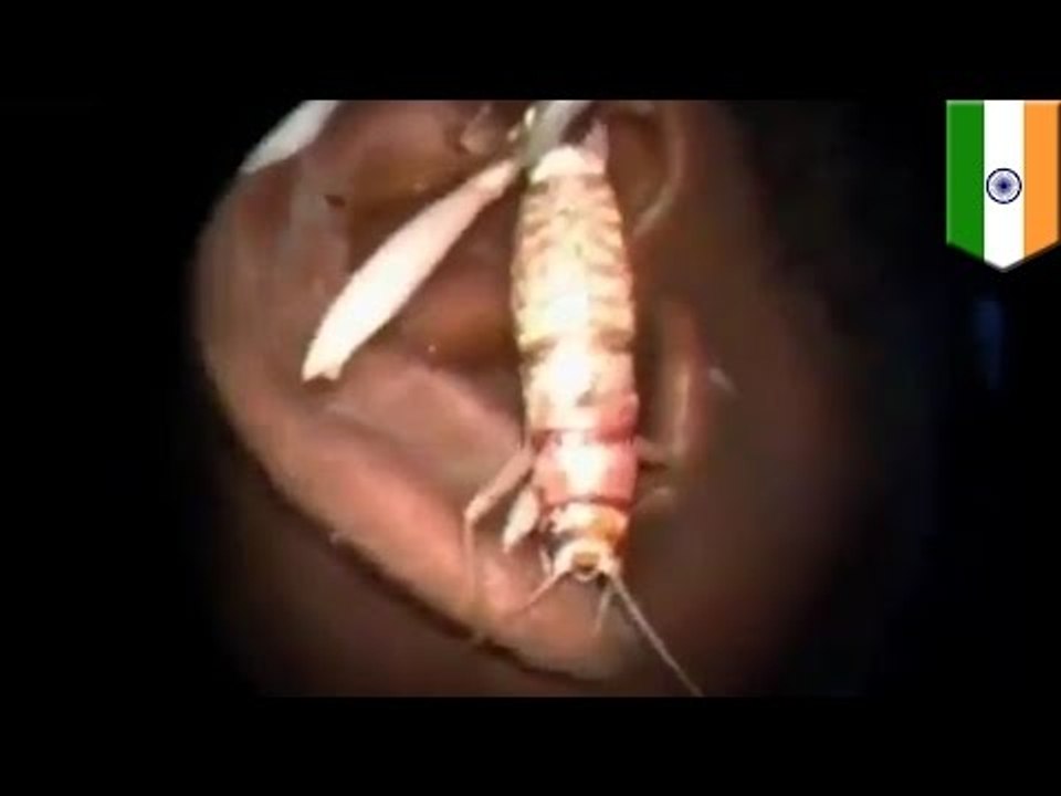 Video de hombre en la india que tenia un enorme insecto en el interior de su oído