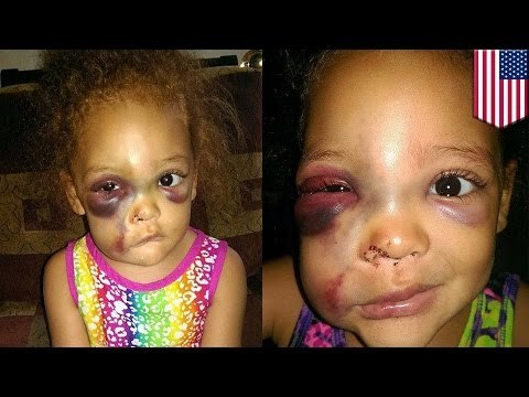 Madre busca justicia en posible caso de matoneo escolar, colegio dice que todo fue un accidente