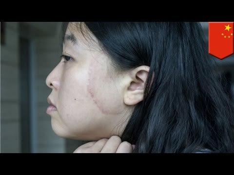 iPhone defectuoso le quema la cara a una mujer después de una larga conversación con su novio