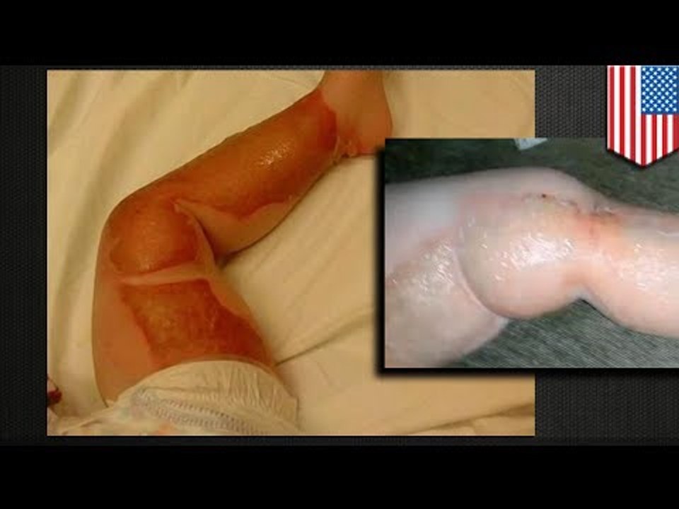 Bebe sufre quemaduras de tercer grado en una guardería, propietario intenta encubrir lo sucedido