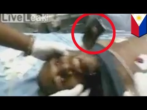 Doctores remueven un teléfono celular que de alguna manera se atoro en la garganta de un hombre