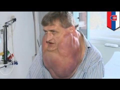 Doctores extirpan un tumor de 6 kilos de la cara de un hombre en Eslovaquia