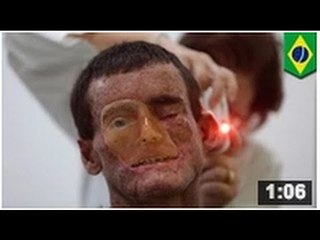 Brésil où La maladie génétique xeroderma pigmentosum est la plus répandue