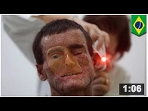 Brésil où La maladie génétique xeroderma pigmentosum est la plus répandue