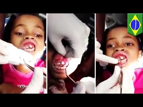 Maggots in mouth: 15 live maggots pulled from Brazilian girl’s gums