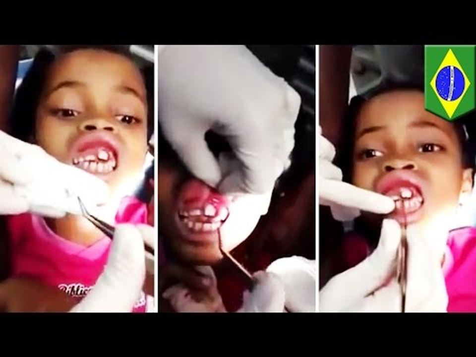 Maggots in mouth: 15 live maggots pulled from Brazilian girl’s gums
