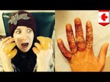 Frostbite photos: Drunk Aussie girl nearly loses her fingers after passing out in Canadian field