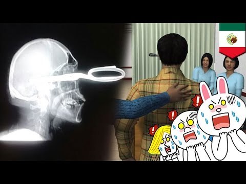 Mężczyzna wbija nożyczki w głowę przeciwnika podczas sprzeczki w barze