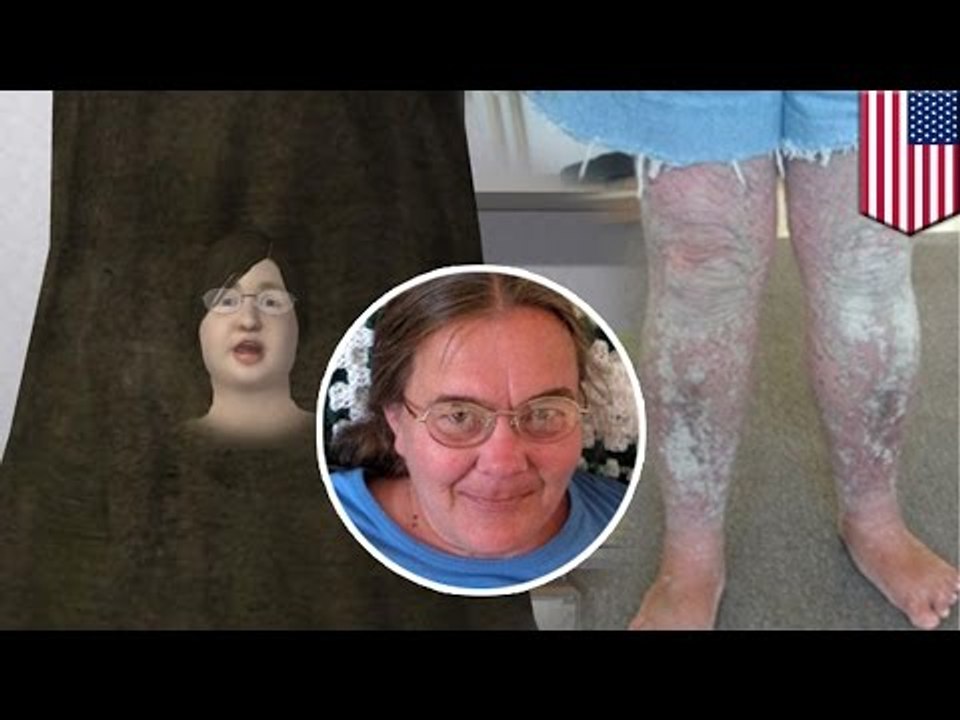 Kobieta odrzucona przez społeczeństwo przez swoją rzadką chorobę skóry