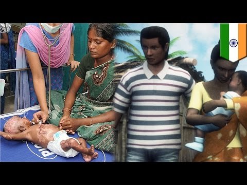 Spontaneous baby combustion? Bad parents say baby set himself on fire in India