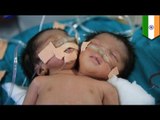 Conjoined twins sa India, namatay, tatlong linggo matapos silang ipanganak