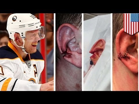 NHL player Christian Ehrhoff, napunit ang tenga dahil sa hockey puck!