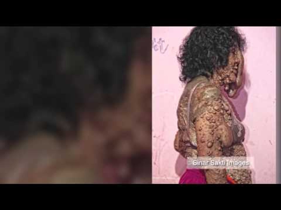 Indonesian na babae, tinakwil ng pamilya dahil sa kanyang kakaibang skin disease!