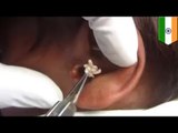 Maggot infestation: doctor removes maggot colony from man’s ear