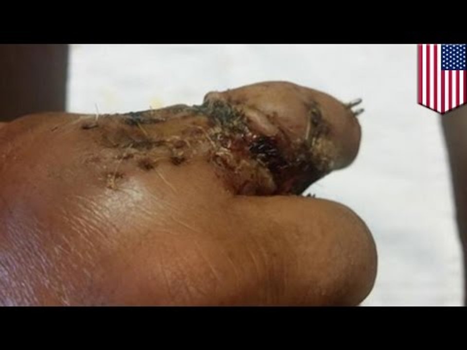 Jose Canseco says finger fell off during poker tournament, posts graphic and very gross photos
