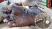 Shocking images show parasitic ‘jigger’ fleas burrowed into human skin