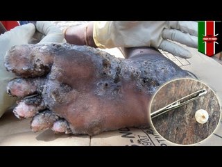 Shocking images show parasitic ‘jigger’ fleas burrowed into human skin