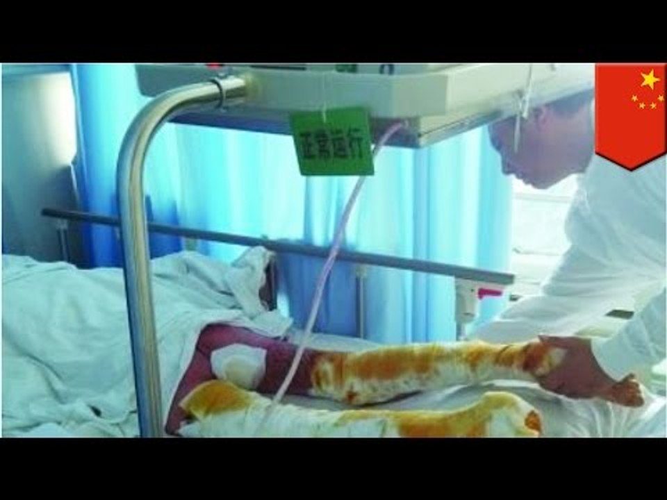 Dumb accident: Pre-teen nearly burned alive after father uses GASOLINE to heal her burn wounds