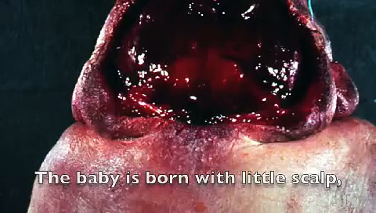 Anencephaly