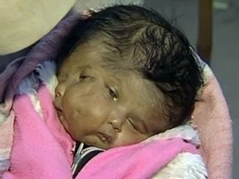 Baby born with two faces, four eyes, two noses, two mouths