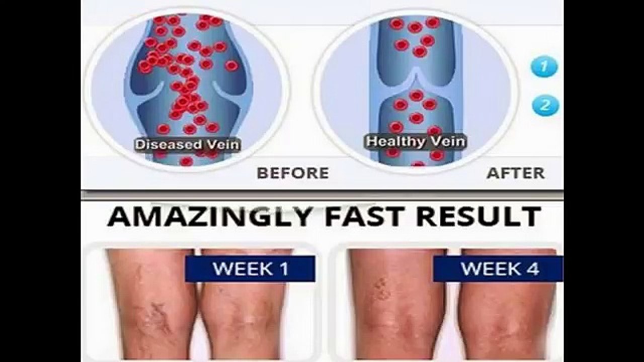 How To Prevent Varicose Veins Naturally Without Surgery - How To Treat Varicose Veins In Legs