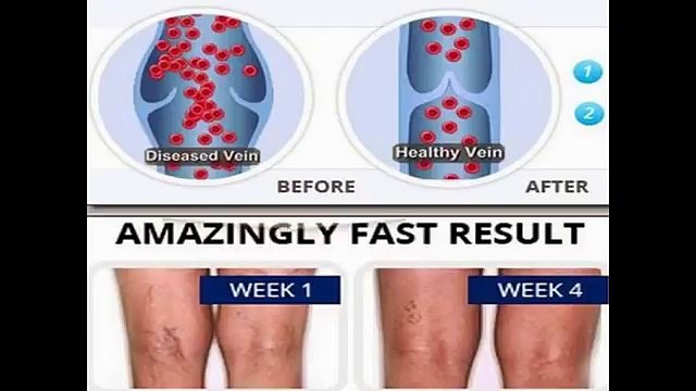 How To Prevent Spider Veins Naturally - How To Get Rid Spider Veins Naturally