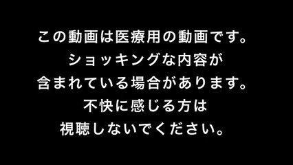 blackhead popping 04