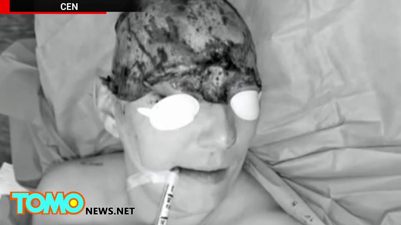 Accident d'une femme scalpée par une perceuse