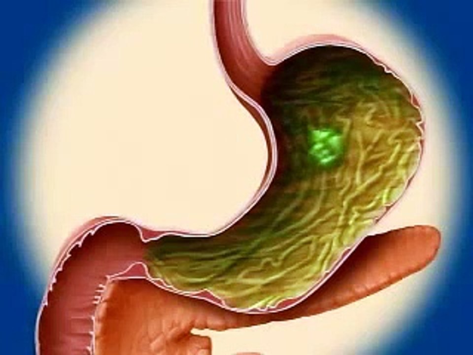 Diabetes Type 2 - What Is Diabetes Mellitus?