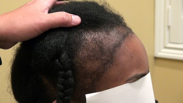 Black Woman Hairline Bald Hair Loss Transplant Restoration Surgery Northern California Dr. Diep mhtaclinic.com