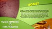 Home Remedies To Treat Keloids | Best Health and Beauty Tips | Lifestyle
