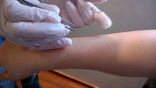 Diode Lazer Uygulama