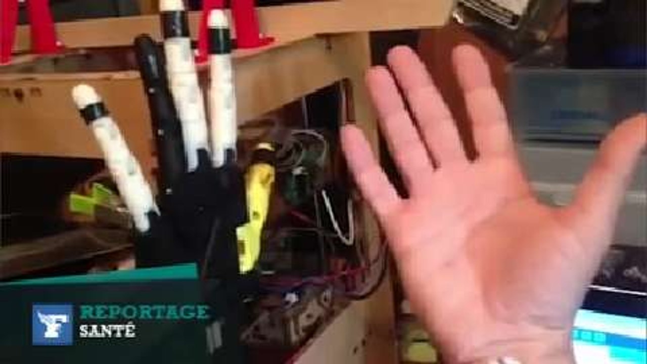 Amputé, il construit lui-même sa main robotisée à bas prix