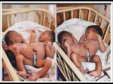 Siamese Twins With Four Hands, 3 Legs And Two Heads Born In Benue State